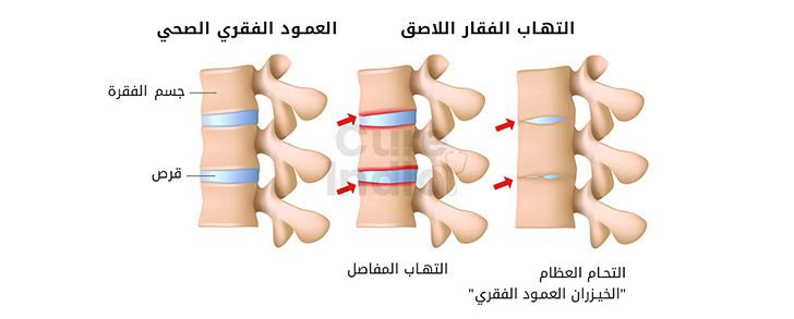 الانصهارالعمود الفقري